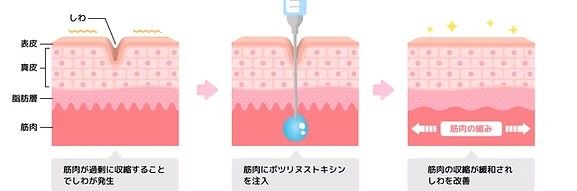 筋肉が過剰に収縮することでしわが発生→筋肉にボツリヌストキシンを注入→筋肉の収縮が緩和されしわを改善